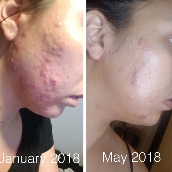 NWT Butter Me Up - Super Acne Fighter - Picture 5 of 5